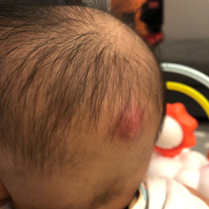 Baby abscess