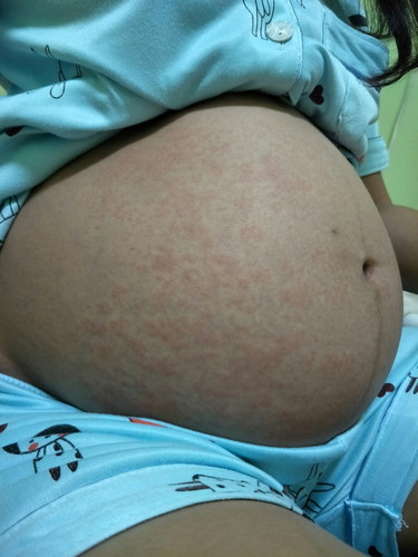 ผื่นขึ้นท้อง และมีอาการคัน
