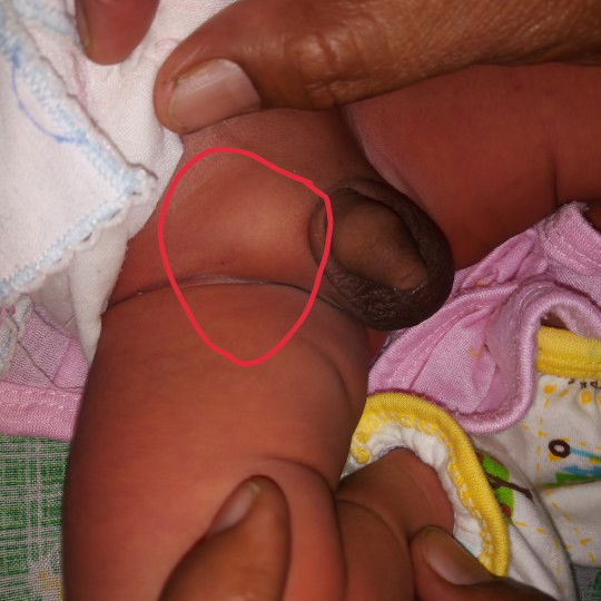 Bendolan dekat kelamin