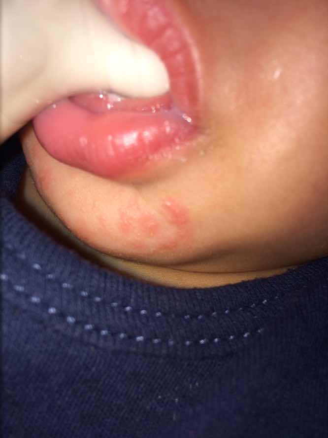 Kemerahan wajah bayi