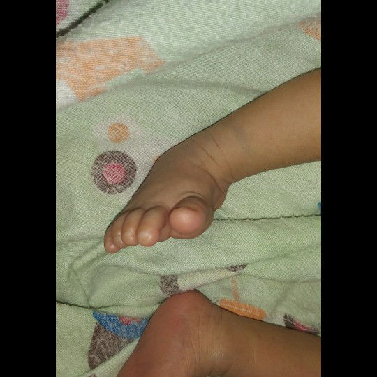 Kaki bayi bengkok (Clubfoot)