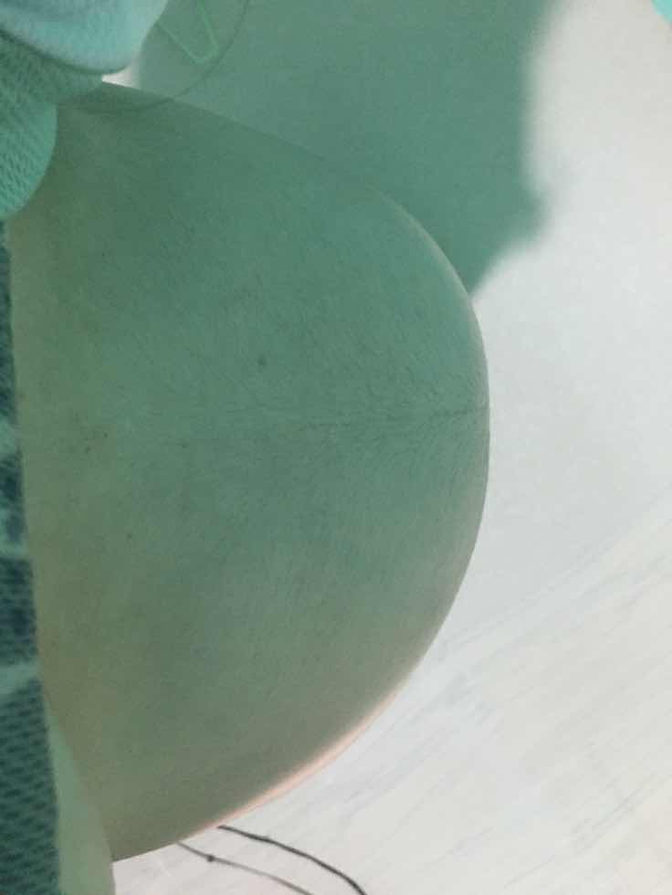 ลูกโก่งตัวด้านเดียว