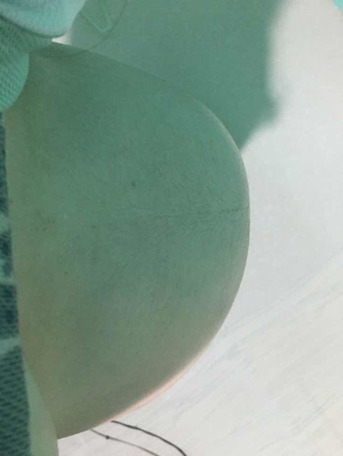 ลูกโก่งตัวด้านเดียว