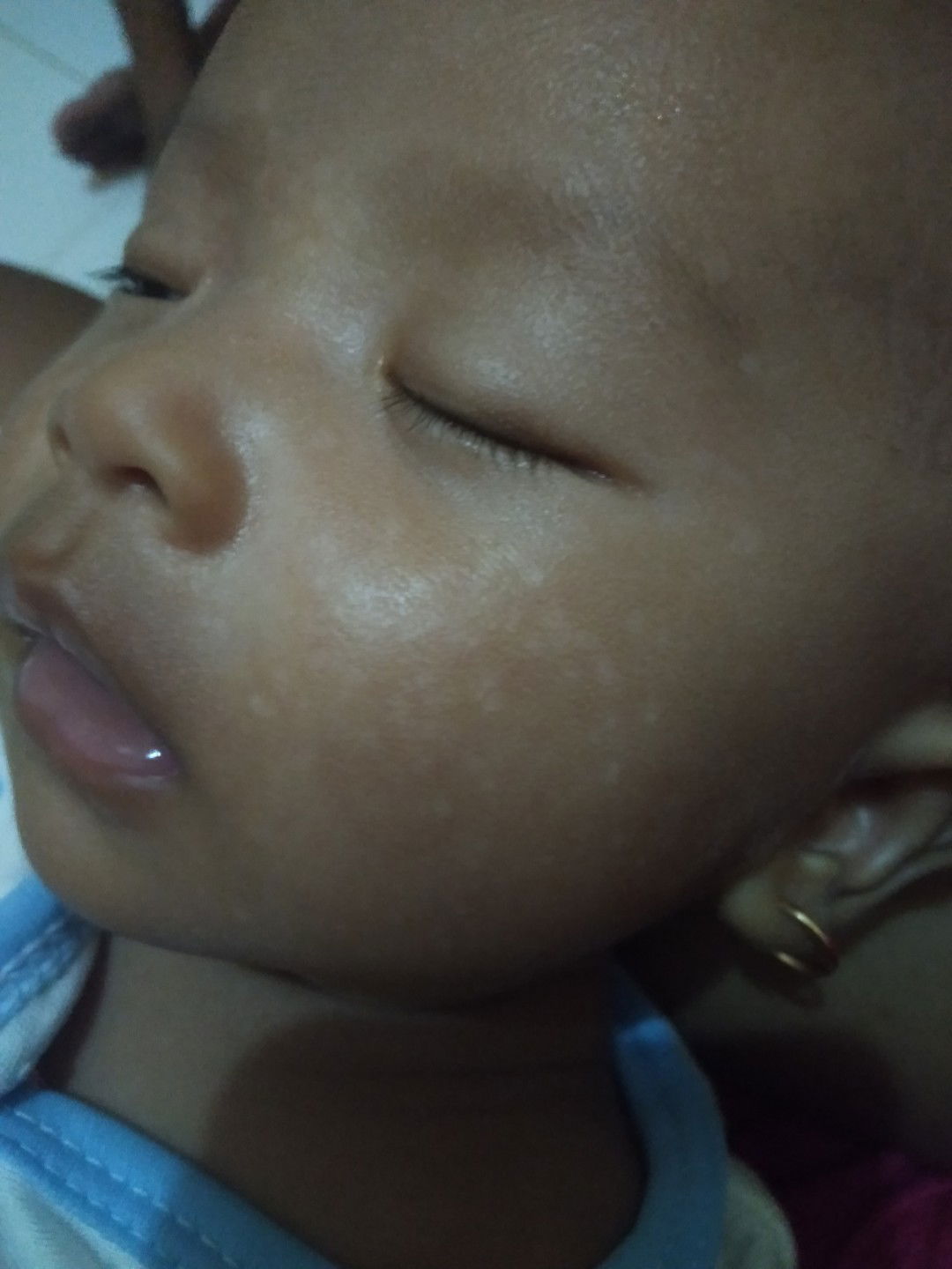 bercak putih pada wajah bayi
