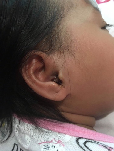 dugo at nana sa tenga