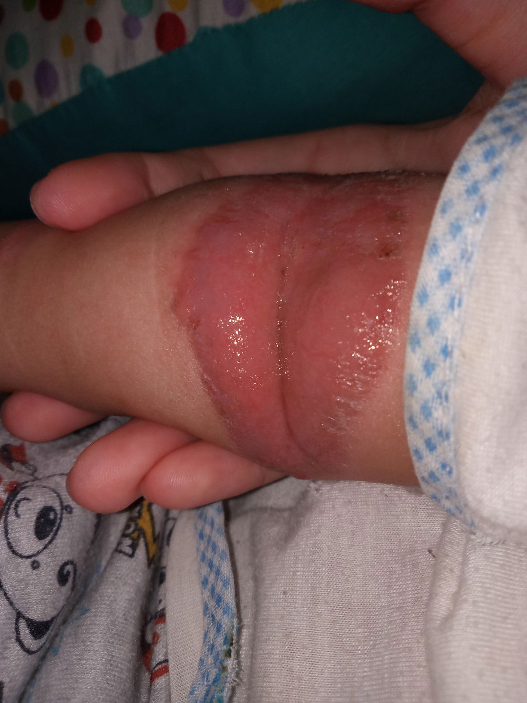 Lipatan tangan berair