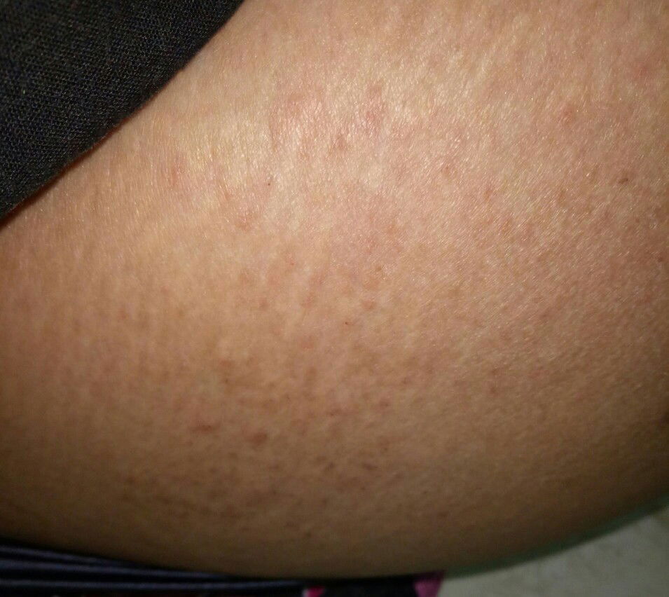 Ruam Kulit Saat Hamil Muda