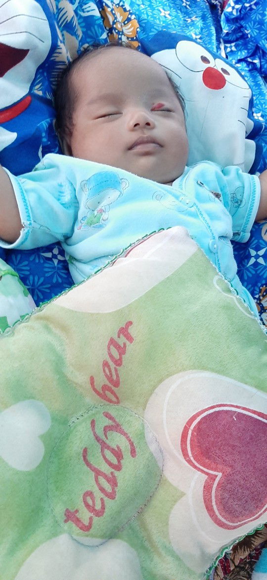 merah dikelopak mata