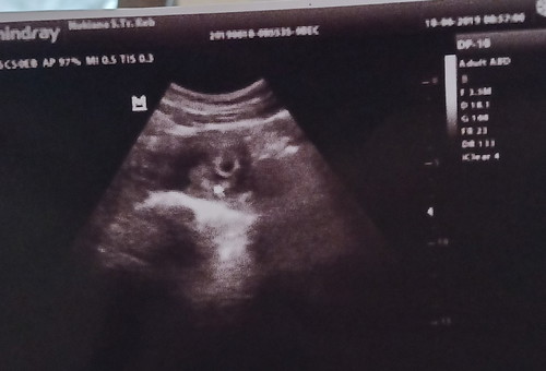 hasil USG perkiraan 6-7 weeks