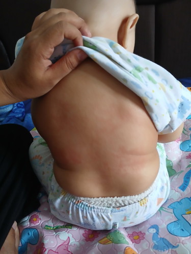 Kulit kering dan merah