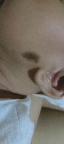 Birth marks?