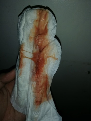 Bleeding with discharge