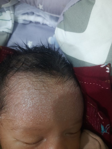 Kerak pada jidat bayi