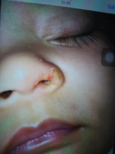 luka di hidung awal nya karena pilek