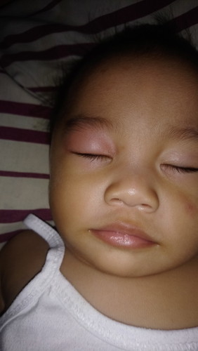 INSECT BITE