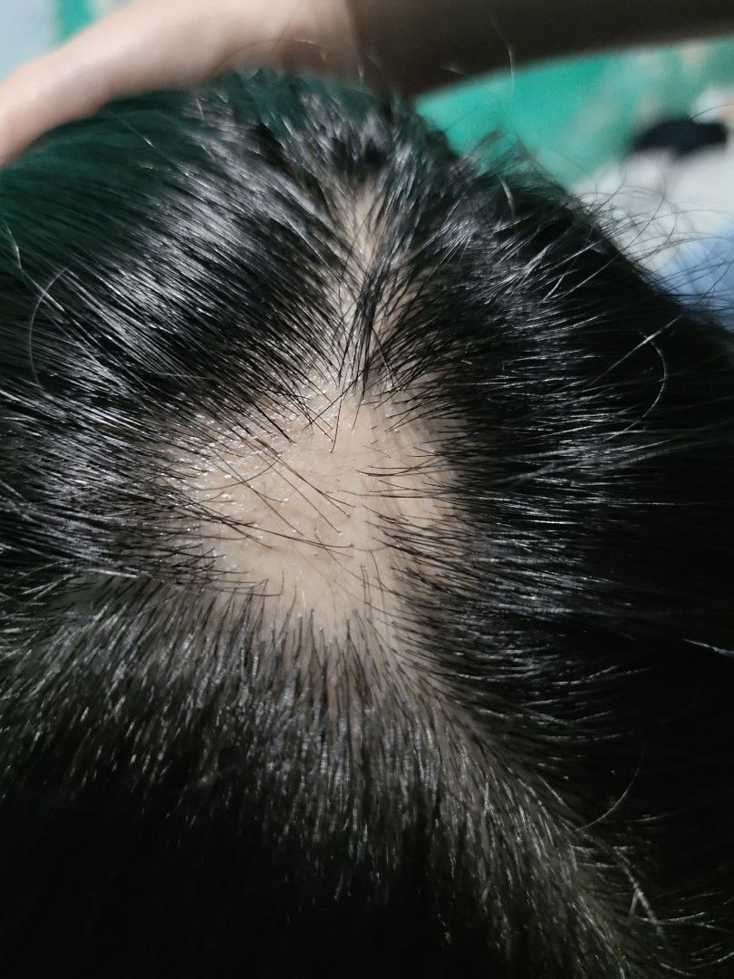 rambut jadi pitak