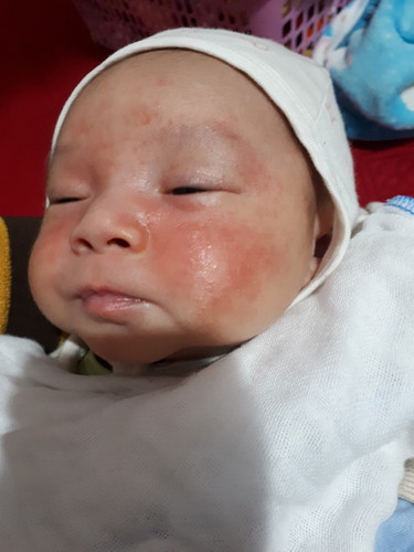 con mình da cứ mẩn đỏ thế này ko biết bị gì,ai có con bị như thế này đã khỏi ko?