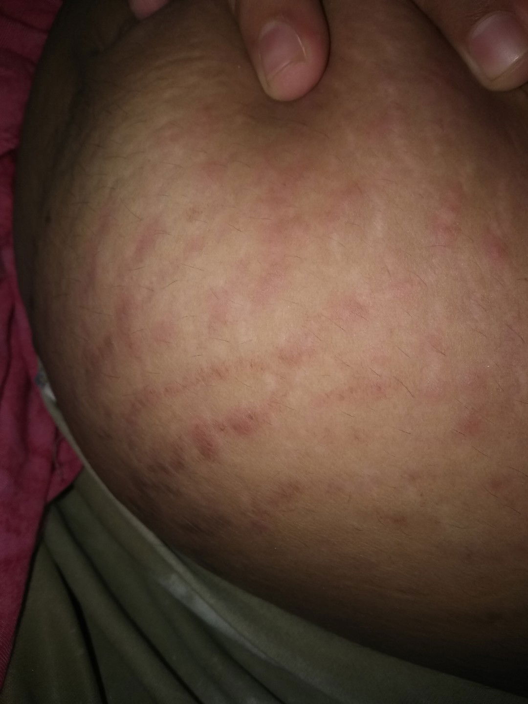 gatal" di perut sampe muncul bintik merah.