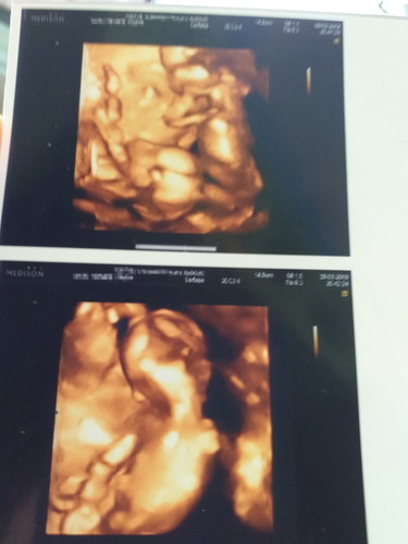 sharing janin kembar