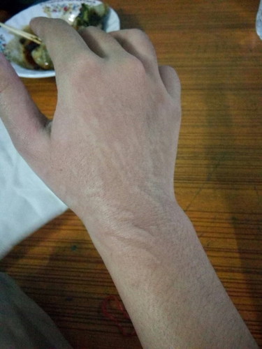 ผื่นขึ้นตามตัว