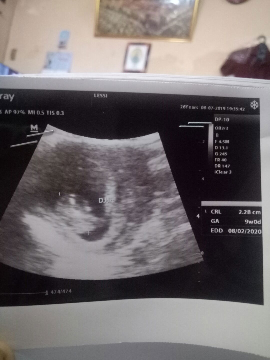 menghitung umur kehamilan