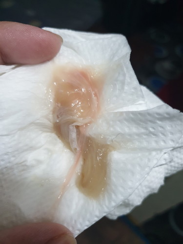 mucus plug