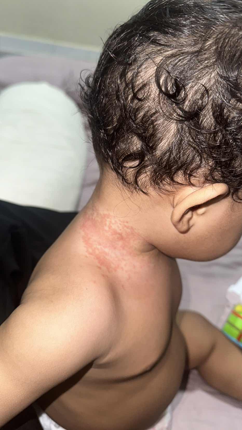 Leher naik ruam merah nak sapu apa ye