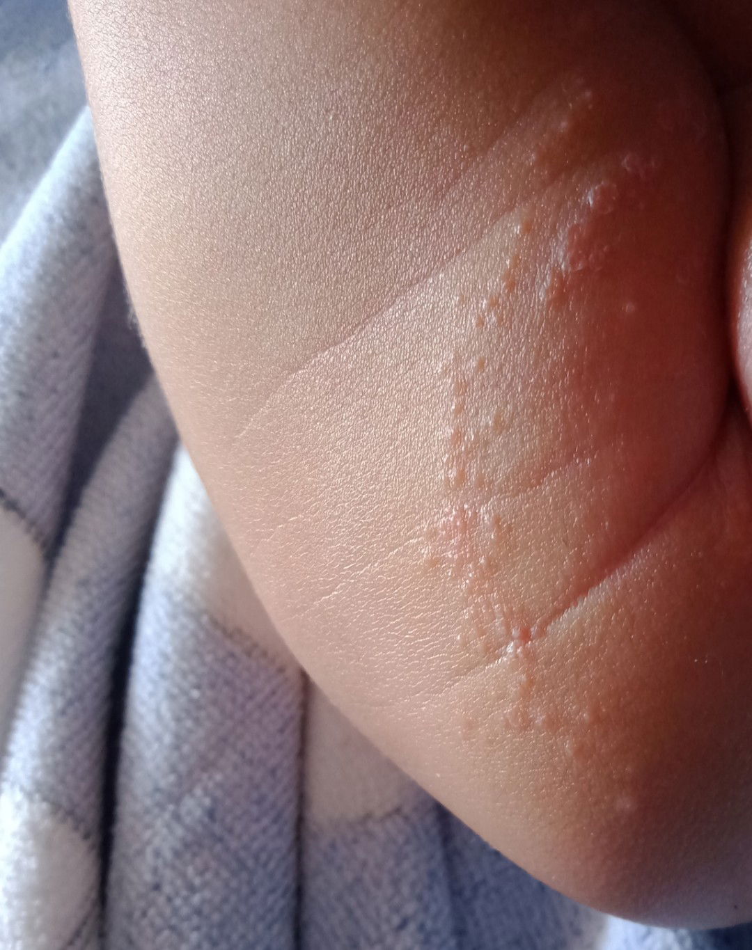 bruntusan d selangkangan