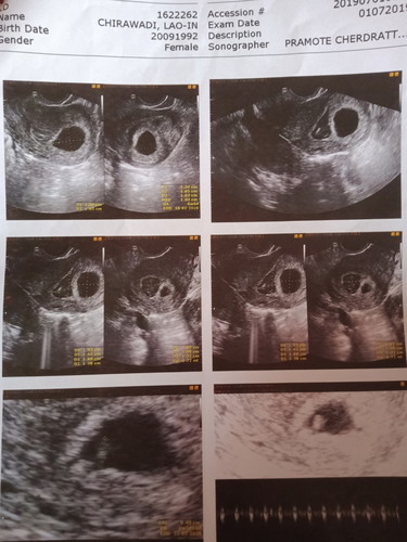 ภาวะแท้งคุกคาม 6w4d