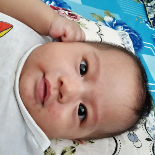 Bé bị nổi mẫn đỏ quanh miệng.