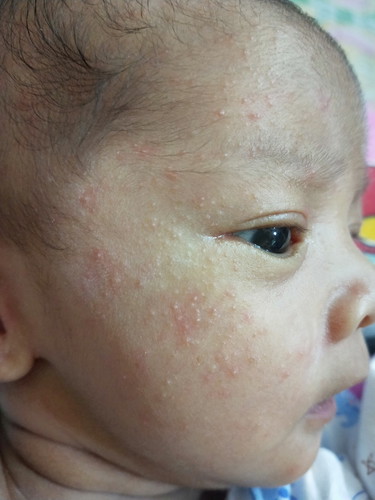 ผื่นแดงๆที่หน้าลูก