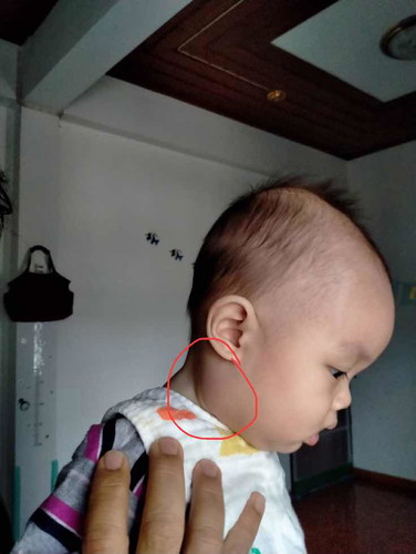 ต่อมน้ำเหลืองอักเสบ