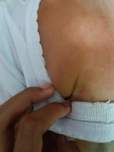 kulit belang bayi