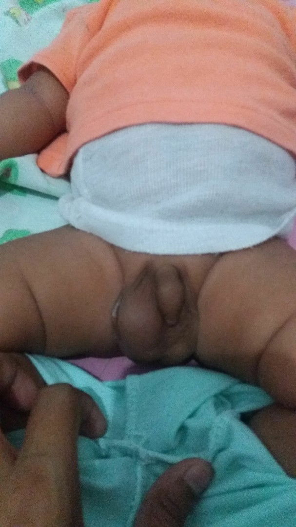 testis bayi blm turun sebelah
