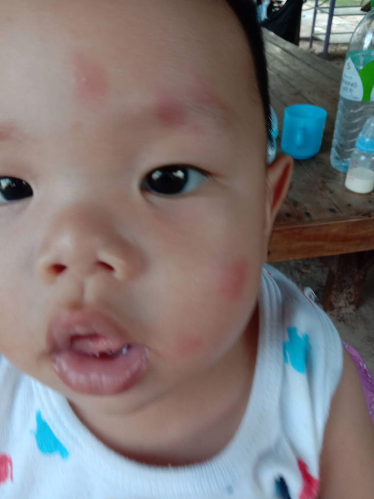 ผื่นแดง