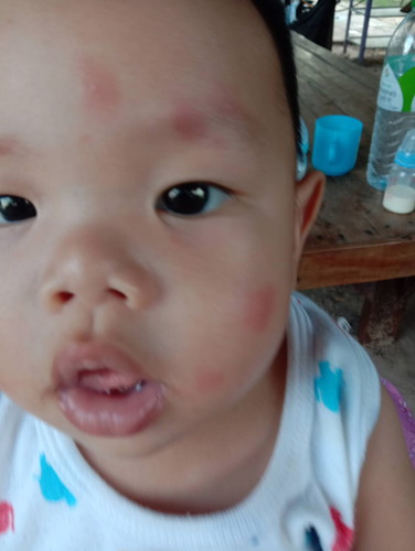 ผื่นแดง