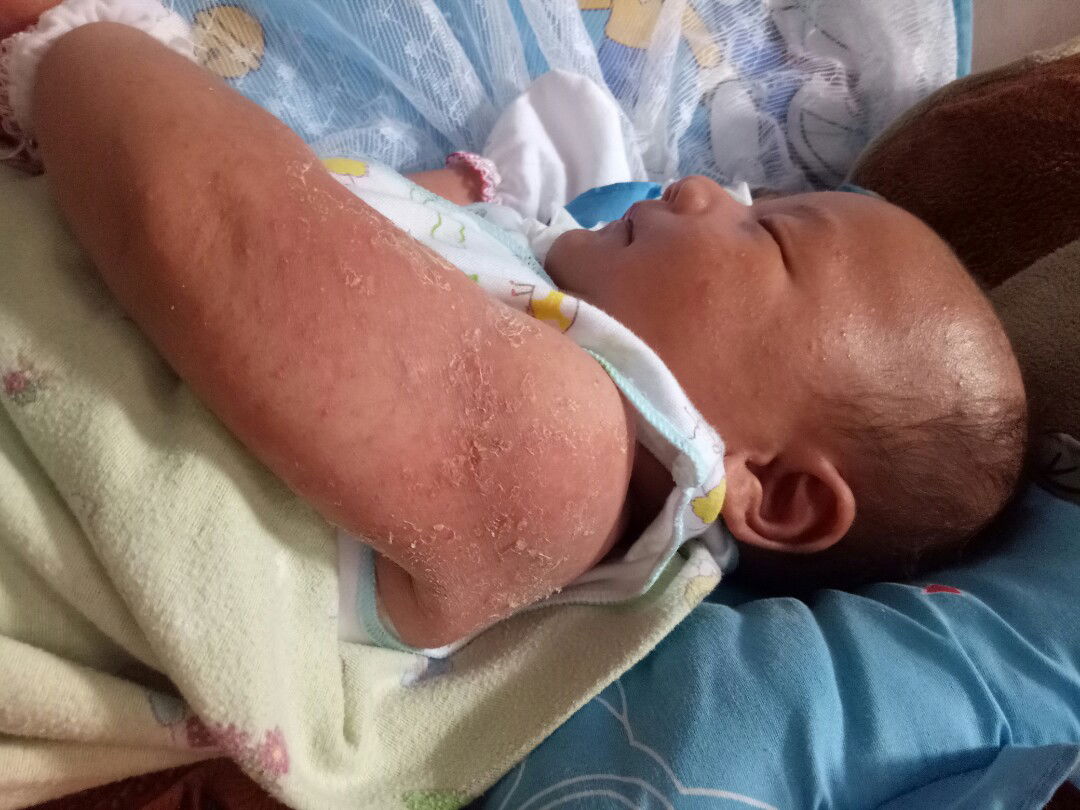 kulit mngelupas dan ruam