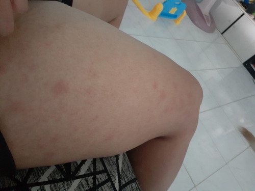 มีแม่ทานไหนที่ผ่าคลอดน้องแล้วมีผื่นขึ้นไหมค่ะแม่บ้านนี้ผ่าคลอดน้องได้2เดือนขึ้นเต็มตัวเลยค่ะ