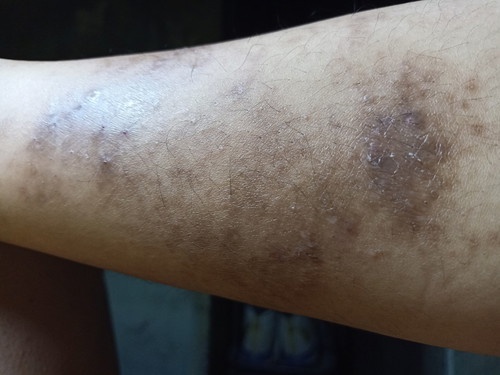 Skin Prob