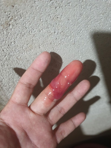 Darah Campur Lendir