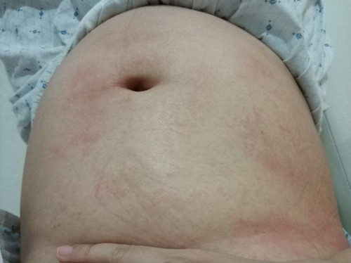 คันหน้าท้อง