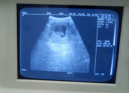 ผลอัลตร้าซาวด์ 7 Week 6 day