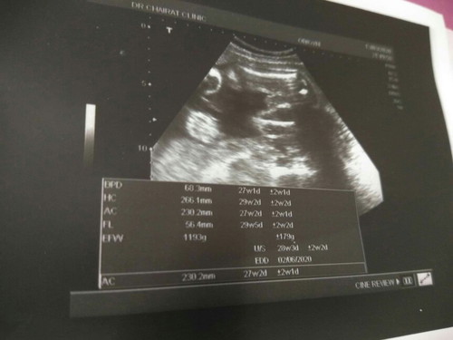 ผลอัลตร้าซาวด์ 27week's 5day กำหนดคลอด8มิ.ย