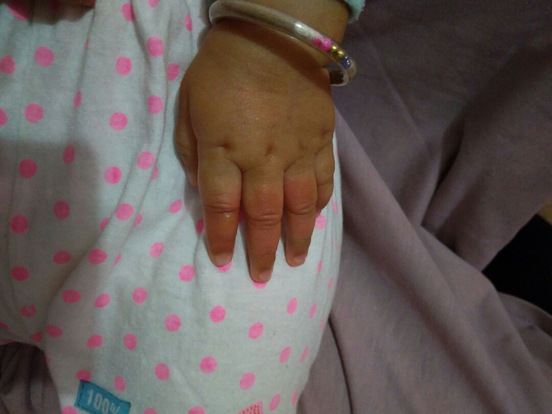 Tangan Kena Air Panas