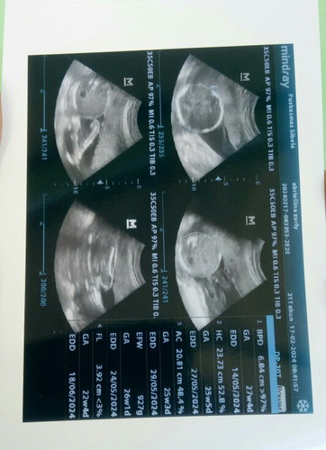Hasil usg 25 week