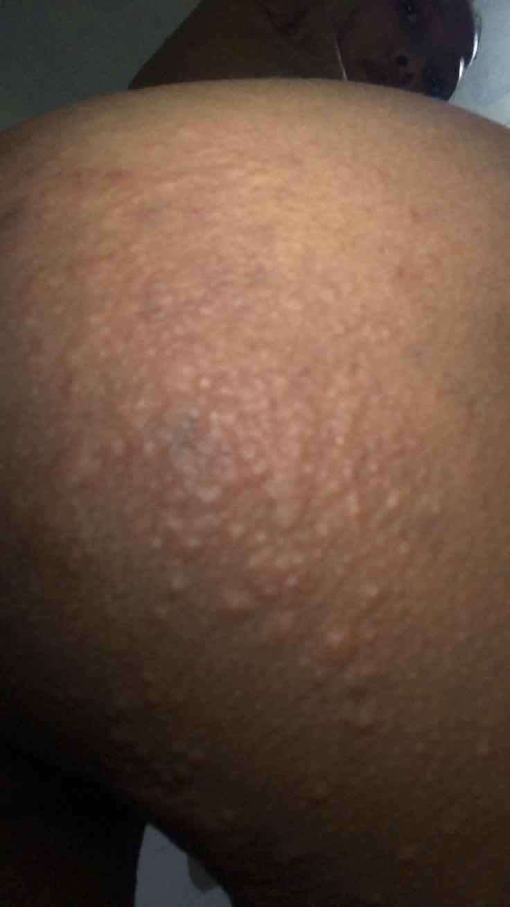 Gatal d sertai bentol