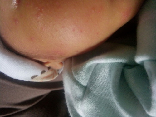 bintik merah pada pipi