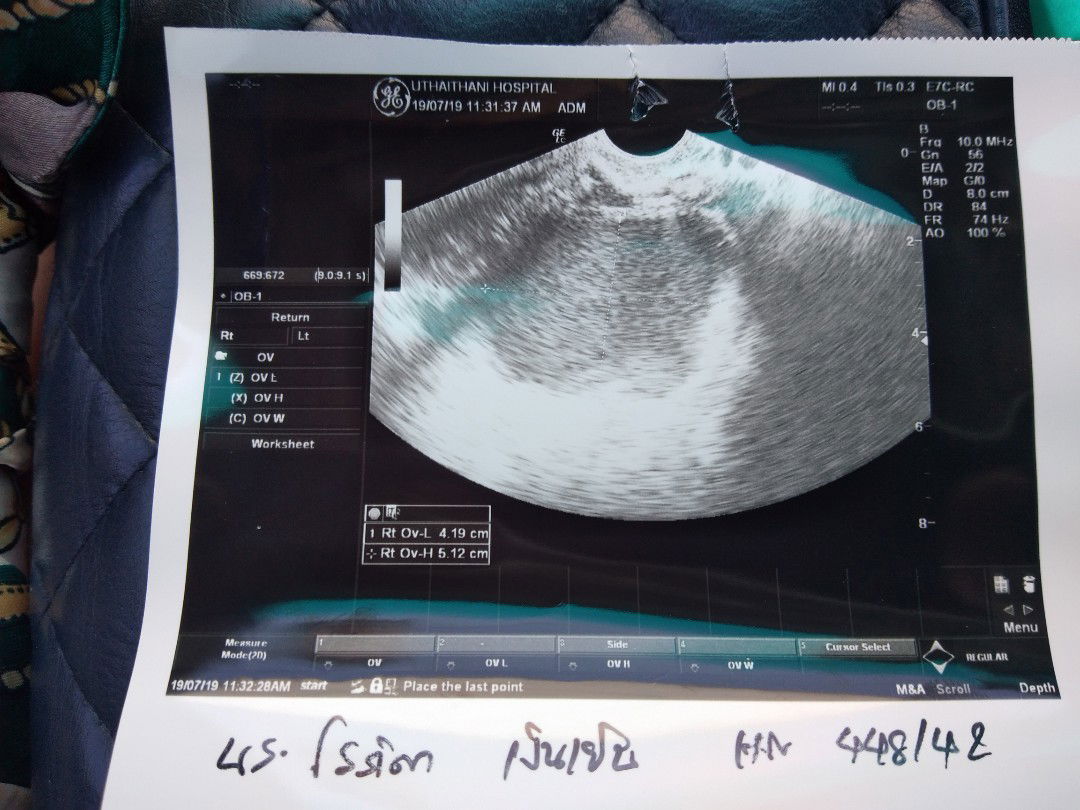 คุณแม่ท่านไหนตั้งครรภ์แล้วตรวจเจอก้อนซีสตรงรังไข่บ้างค่ะ