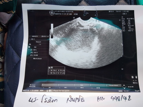 คุณแม่ท่านไหนตั้งครรภ์แล้วตรวจเจอก้อนซีสตรงรังไข่บ้างค่ะ