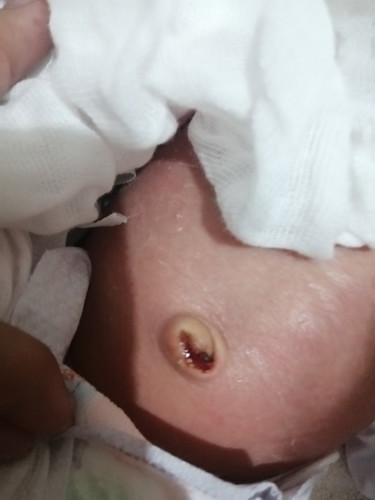 Pusod Ng 1 Week Old Baby